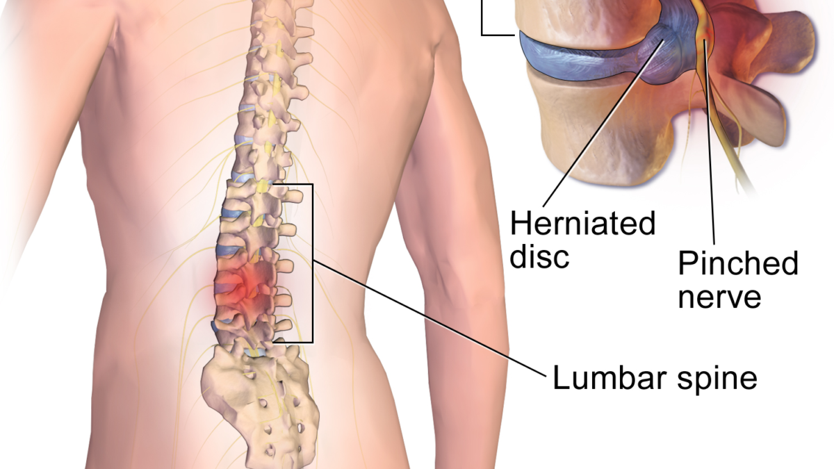 What to Expect Before, During, and After Disc Surgery