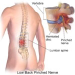 What to Expect Before, During, and After Disc Surgery