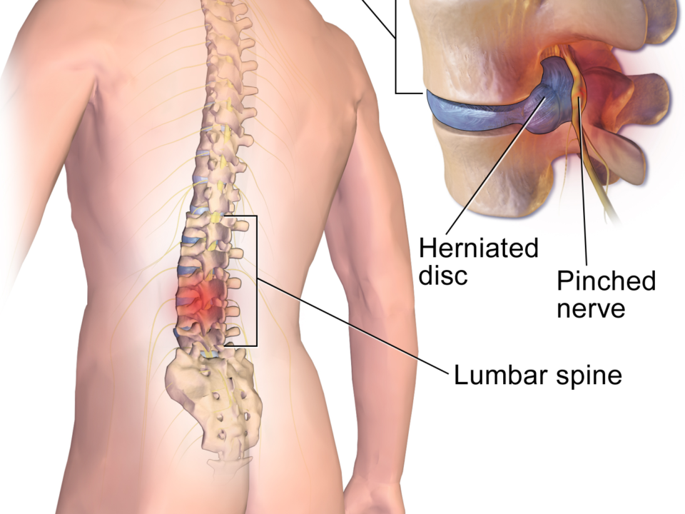 What to Expect Before, During, and After Disc Surgery