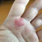 Common Allergic Reactions and How To Treat Them