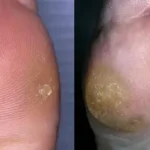 Different Types of Foot Fungus and Their Treatments