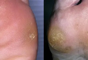 Different Types of Foot Fungus and Their Treatments