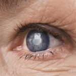 How Cataracts Affect Your Vision