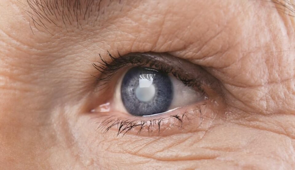 How Cataracts Affect Your Vision