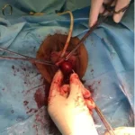 How To Address Symptoms After Gallbladder Removal