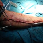 The Benefits of Early Detection in Orthopedic Surgery