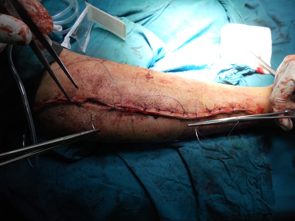 The Benefits of Early Detection in Orthopedic Surgery
