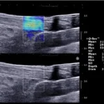 Understanding the Causes and Risks of BV Symptoms