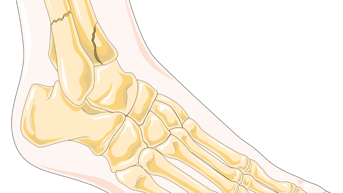 Understanding the Different Types of Ankle Fractures