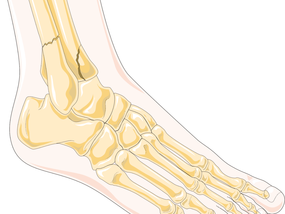 Understanding the Different Types of Ankle Fractures